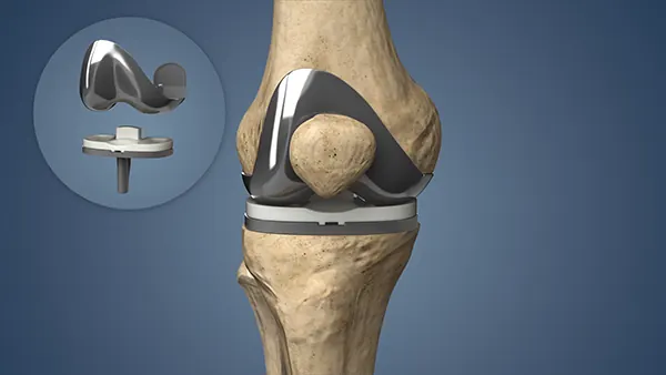 Knee Replacement Surgery in Indore: Signs, Recovery & When to Consult