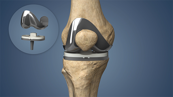 Total Knee Replacement