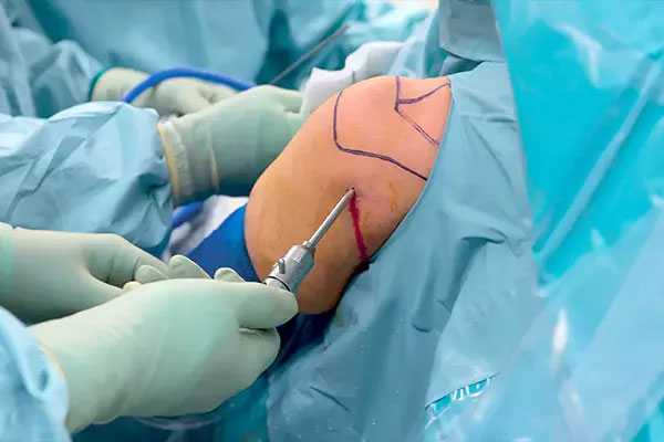 Arthroscopic Ligament Reconstruction