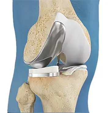 Unicompartmental Knee Replacement