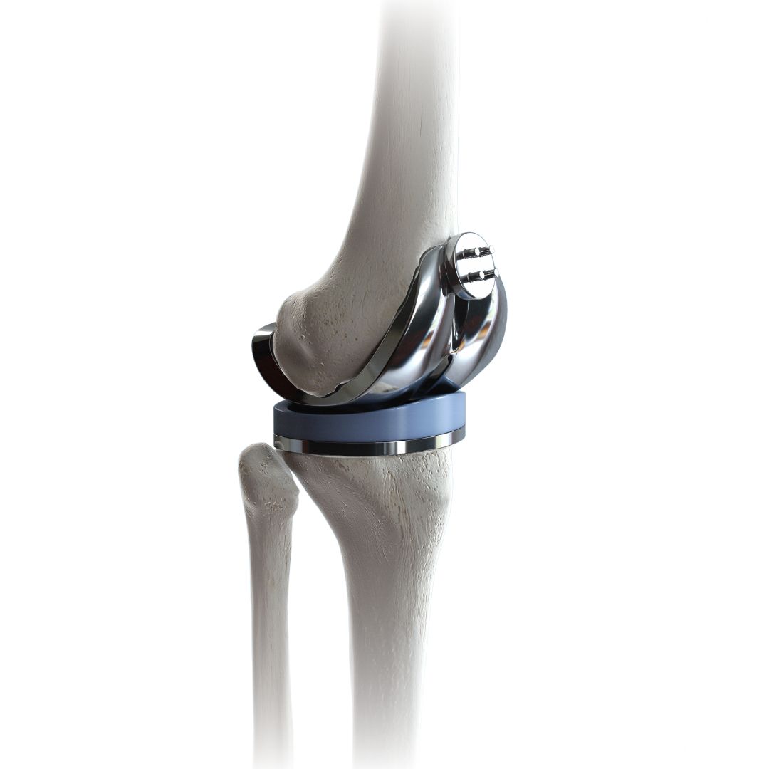 Revision Knee Replacement