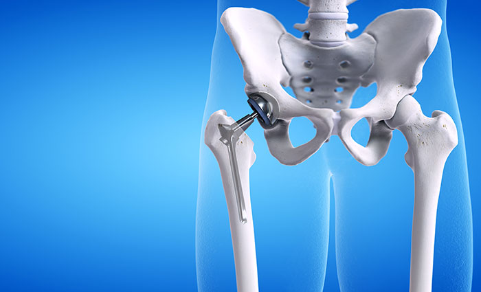 Total Hip Replacement