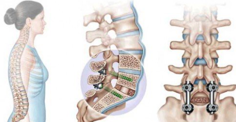 Traumatic Spine Fixation